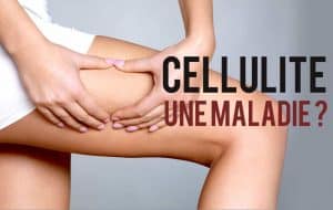 Cellulitis, een lelijke ziekte die het niet is!